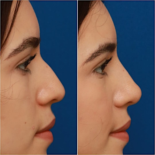 Non-Surgical Rhinoplasty Before & After Gallery - Patient 58233360 - Image 9