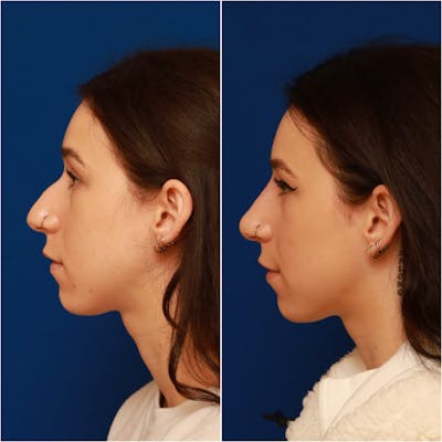 Non-Surgical Rhinoplasty Before & After Gallery - Patient 58233359 - Image 1
