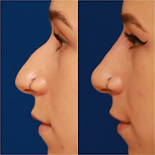Non-Surgical Rhinoplasty Before & After Gallery - Patient 58233359 - Image 2