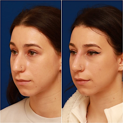 Non-Surgical Rhinoplasty Before & After Gallery - Patient 58233359 - Image 3