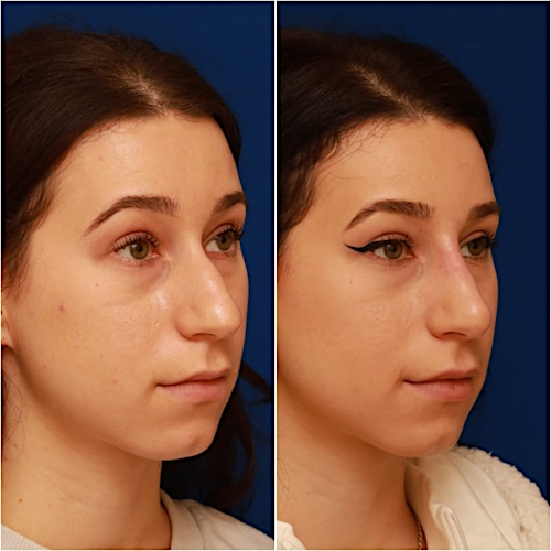 Non-Surgical Rhinoplasty Before & After Gallery - Patient 58233359 - Image 4