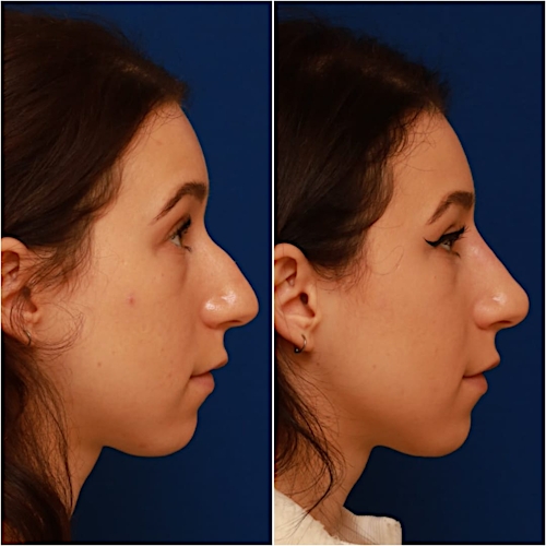 Non-Surgical Rhinoplasty Before & After Gallery - Patient 58233359 - Image 5
