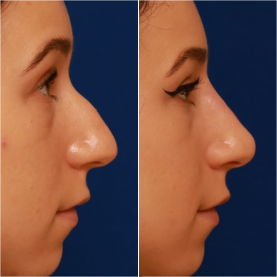 Non-Surgical Rhinoplasty Before & After Gallery - Patient 58233359 - Image 6