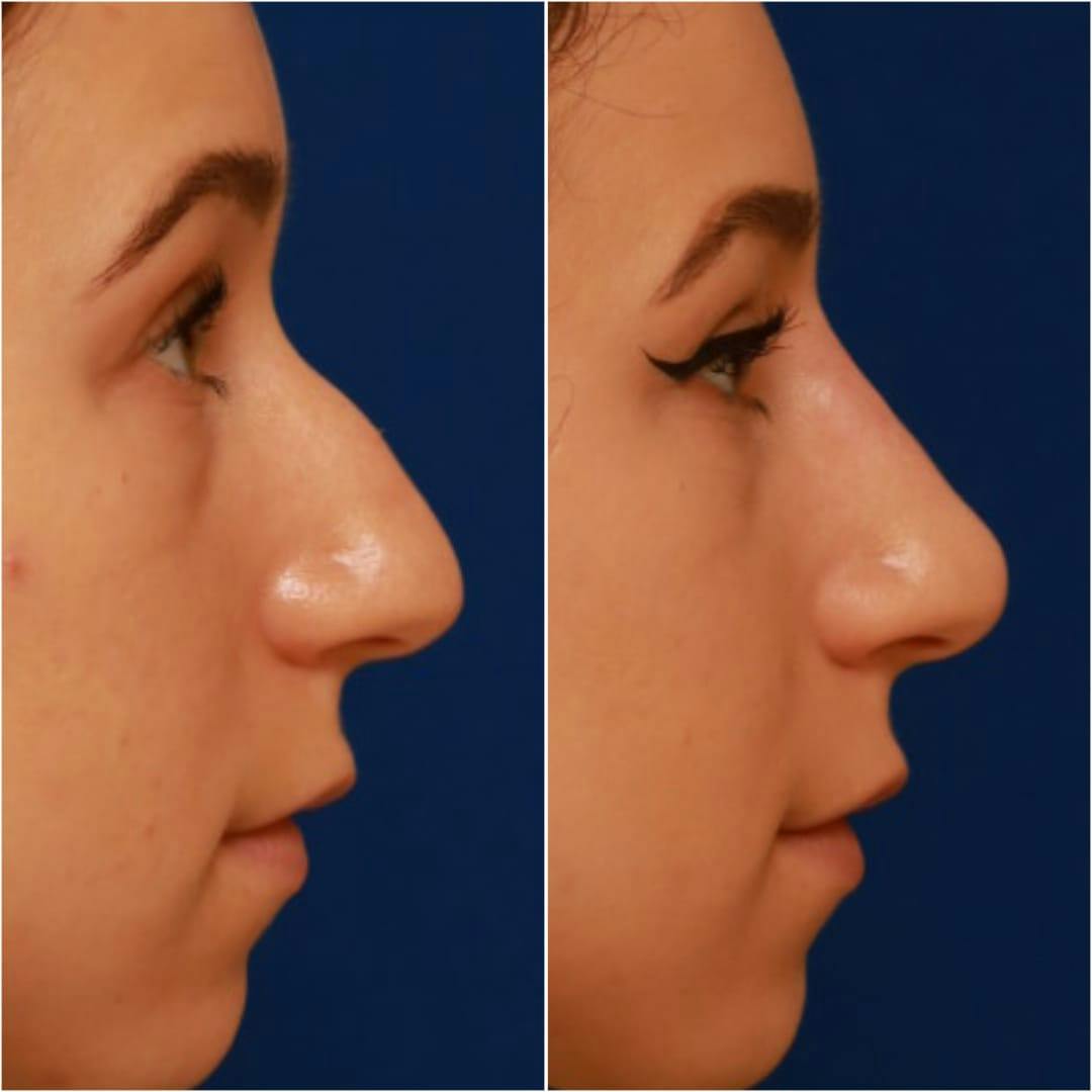 Non-Surgical Rhinoplasty Before & After Gallery - Patient 58233359 - Image 6