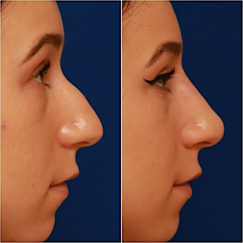 Non-Surgical Rhinoplasty Before & After Gallery - Patient 58233359 - Image 6