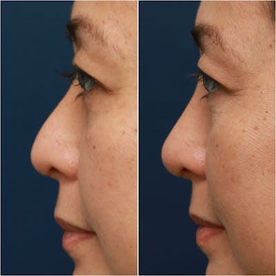 Non-Surgical Rhinoplasty Before & After Gallery - Patient 58233382 - Image 1