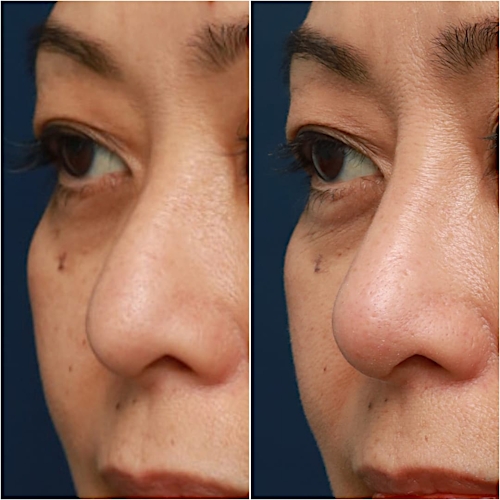 Non-Surgical Rhinoplasty Before & After Gallery - Patient 58233382 - Image 2