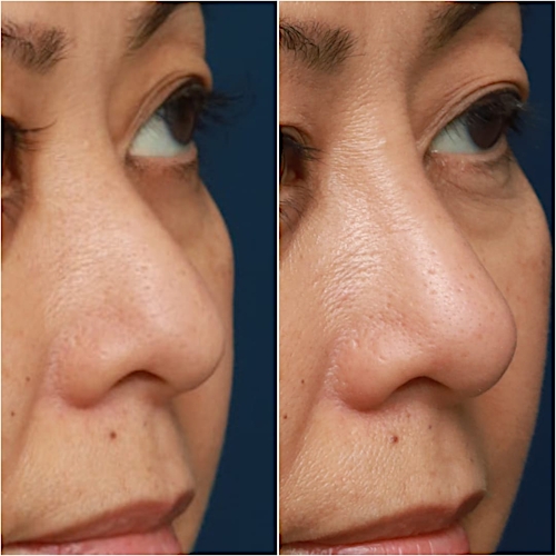 Non-Surgical Rhinoplasty Before & After Gallery - Patient 58233382 - Image 3