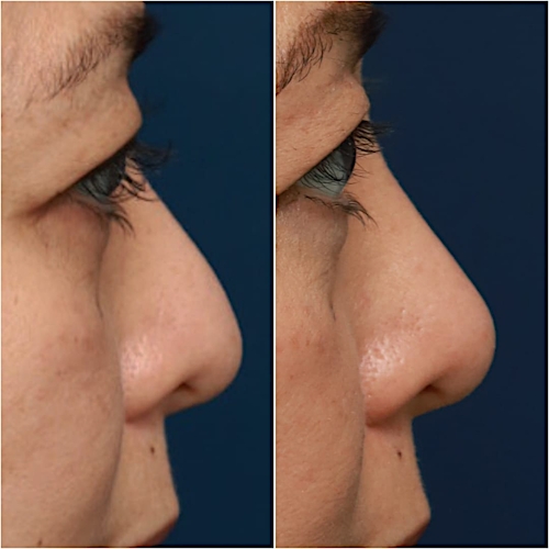 Non-Surgical Rhinoplasty Before & After Gallery - Patient 58233382 - Image 4