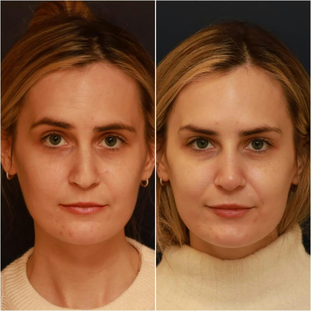 Non-Surgical Rhinoplasty Before & After Gallery - Patient 58233381 - Image 2