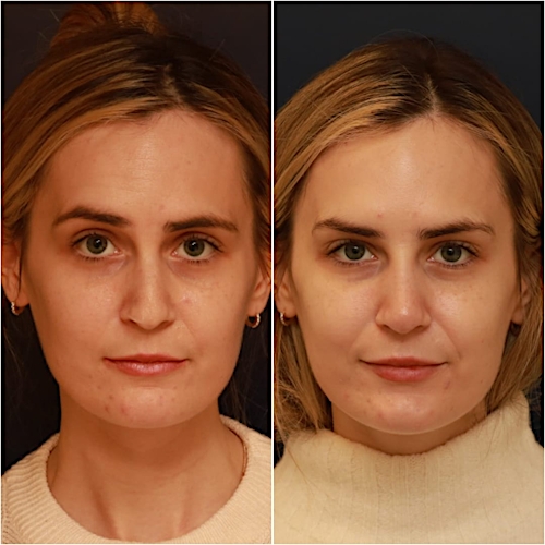 Non-Surgical Rhinoplasty Before & After Gallery - Patient 58233381 - Image 2