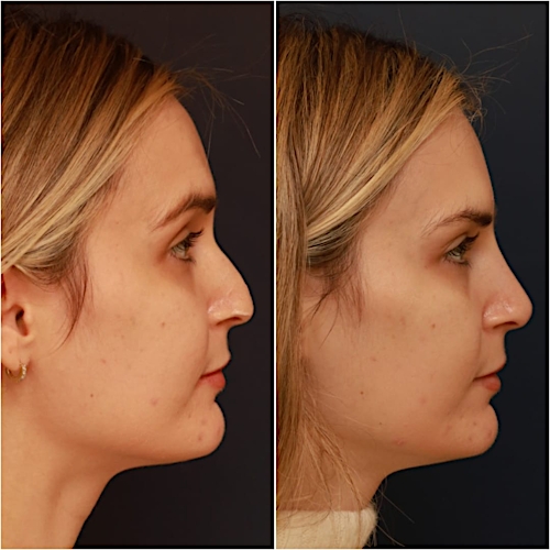 Non-Surgical Rhinoplasty Before & After Gallery - Patient 58233381 - Image 3