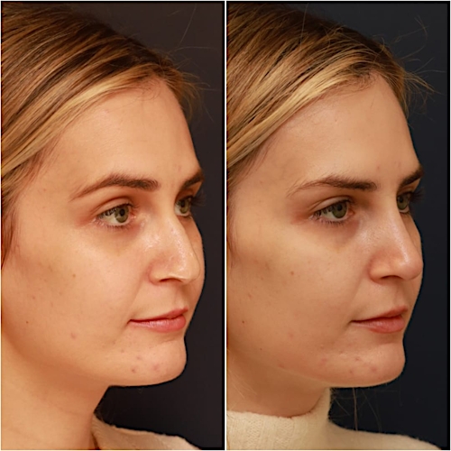 Non-Surgical Rhinoplasty Before & After Gallery - Patient 58233381 - Image 4