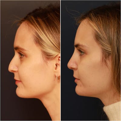 Non-Surgical Rhinoplasty Before & After Gallery - Patient 58233381 - Image 1