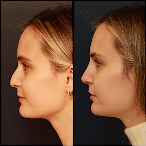 Non-Surgical Rhinoplasty Before & After Gallery - Patient 58233381 - Image 1