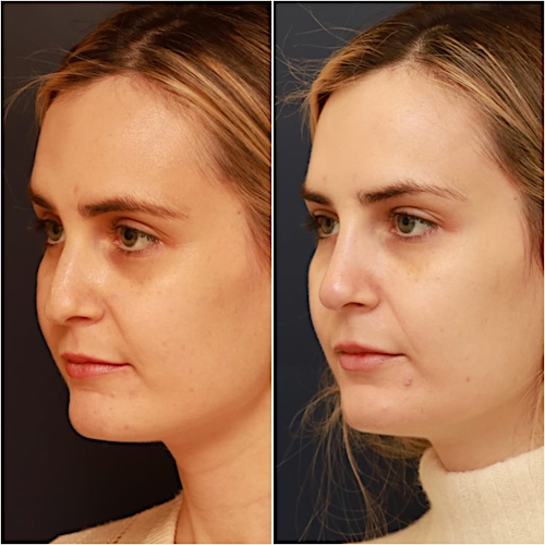 Non-Surgical Rhinoplasty Before & After Gallery - Patient 58233381 - Image 5