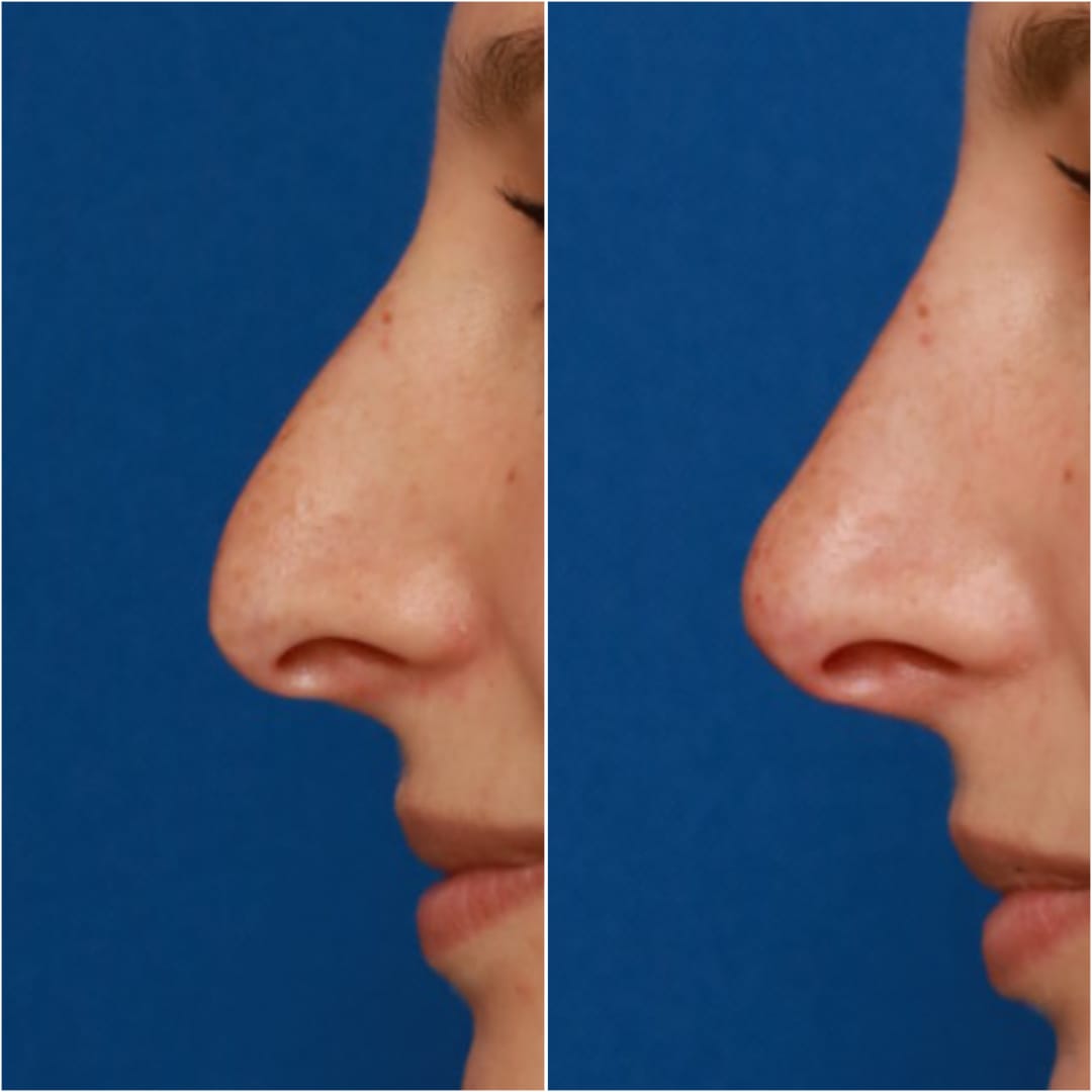 Non-Surgical Rhinoplasty Before & After Gallery - Patient 58233383 - Image 1