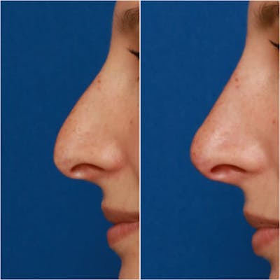 Non-Surgical Rhinoplasty Before & After Gallery - Patient 58233383 - Image 1