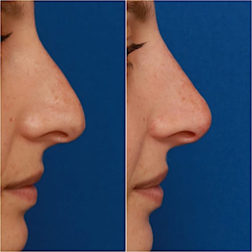 Non-Surgical Rhinoplasty Before & After Gallery - Patient 58233383 - Image 2