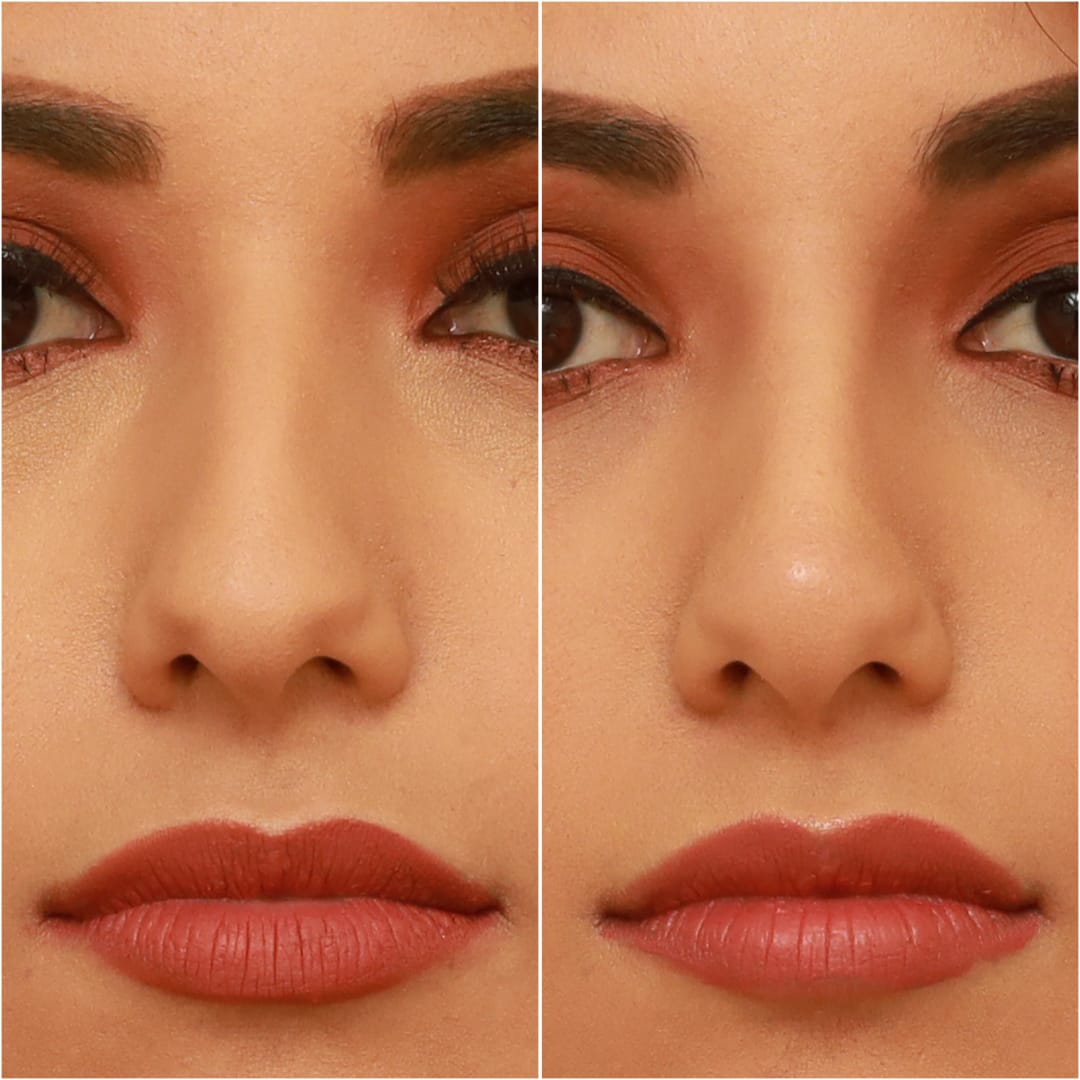 Non-Surgical Rhinoplasty Before & After Gallery - Patient 58233384 - Image 2