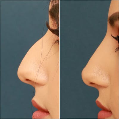 Non-Surgical Rhinoplasty Before & After Gallery - Patient 58233384 - Image 1