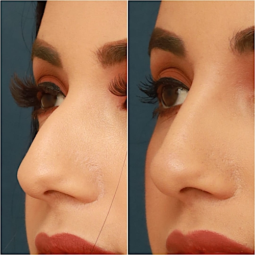 Non-Surgical Rhinoplasty Before & After Gallery - Patient 58233384 - Image 3