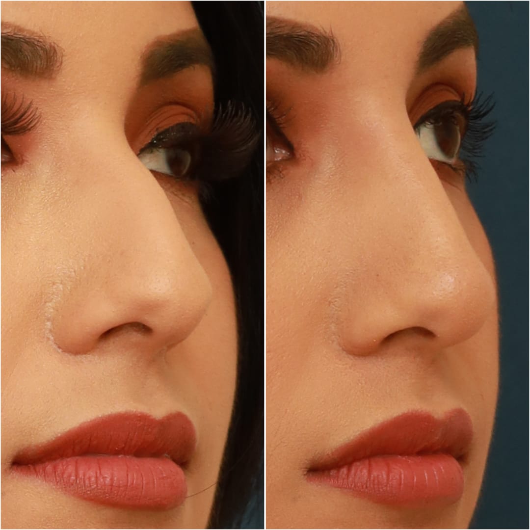 Non-Surgical Rhinoplasty Before & After Gallery - Patient 58233384 - Image 4