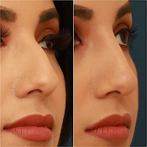 Non-Surgical Rhinoplasty Before & After Gallery - Patient 58233384 - Image 4