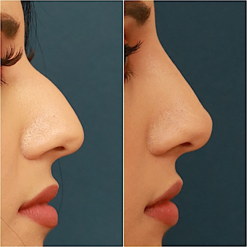 Non-Surgical Rhinoplasty Before & After Gallery - Patient 58233384 - Image 5