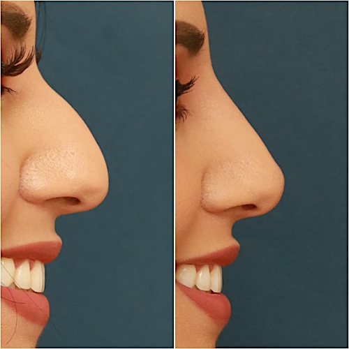 Non-Surgical Rhinoplasty Before & After Gallery - Patient 58233384 - Image 6