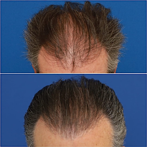 FUT Hair Restoration Before & After Gallery - Patient 58233403 - Image 1