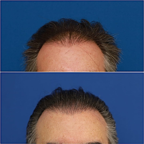 FUT Hair Restoration Before & After Gallery - Patient 58233403 - Image 2