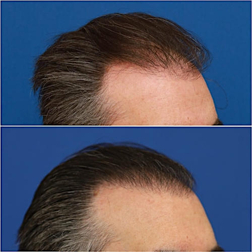 FUT Hair Restoration Before & After Gallery - Patient 58233403 - Image 3