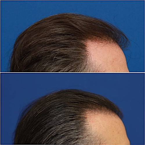 FUT Hair Restoration Before & After Gallery - Patient 58233403 - Image 4