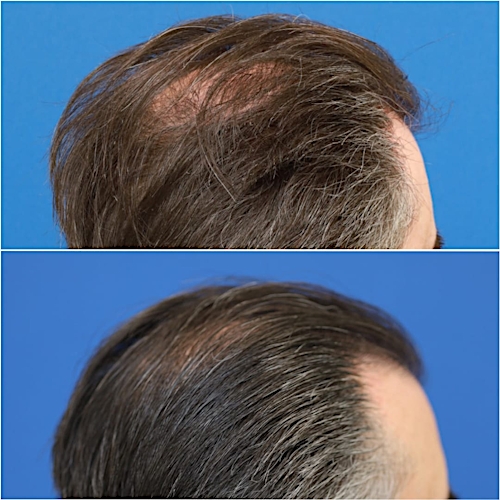 FUT Hair Restoration Before & After Gallery - Patient 58233403 - Image 5