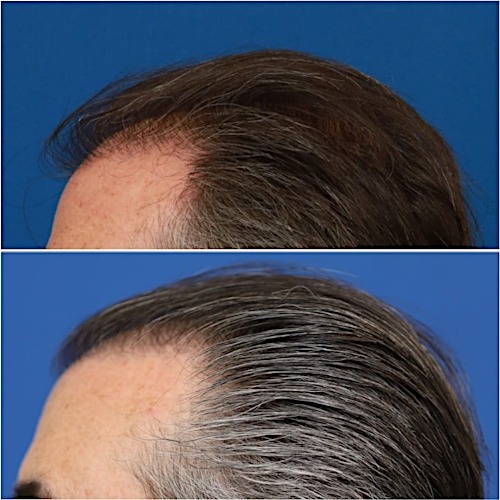FUT Hair Restoration Before & After Gallery - Patient 58233403 - Image 6