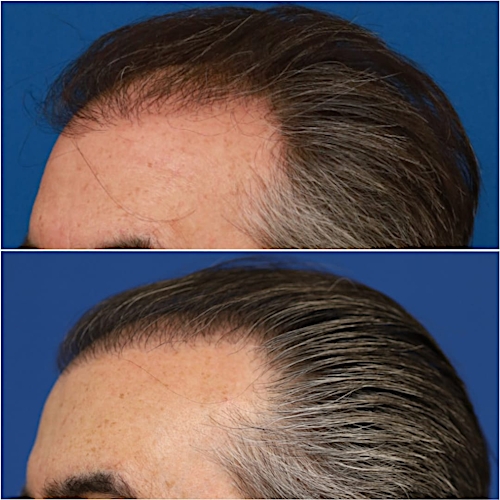 FUT Hair Restoration Before & After Gallery - Patient 58233403 - Image 7