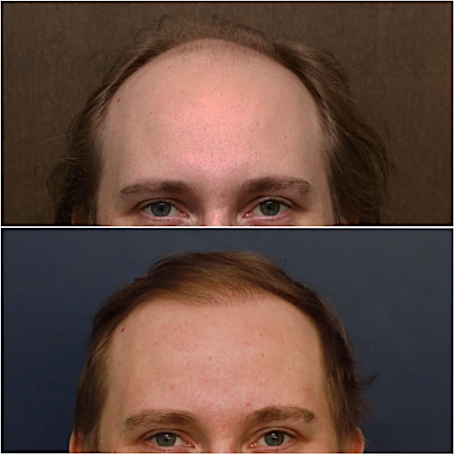 FUT Hair Restoration Before & After Gallery - Patient 58233406 - Image 2