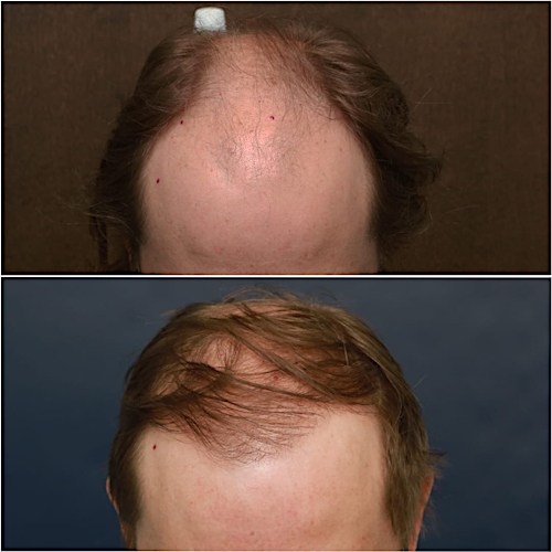 FUT Hair Restoration Before & After Gallery - Patient 58233406 - Image 1