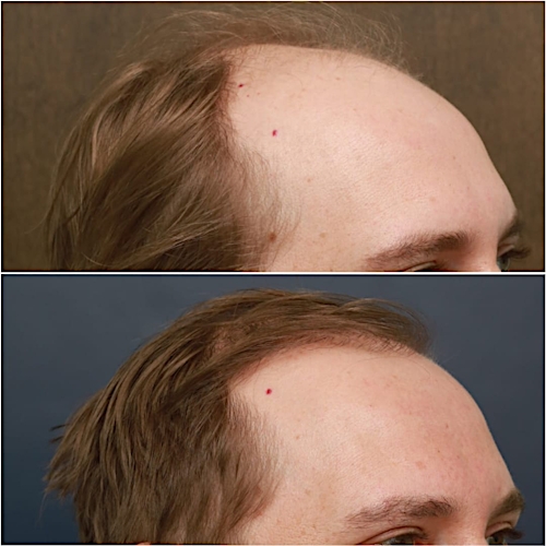 FUT Hair Restoration Before & After Gallery - Patient 58233406 - Image 3