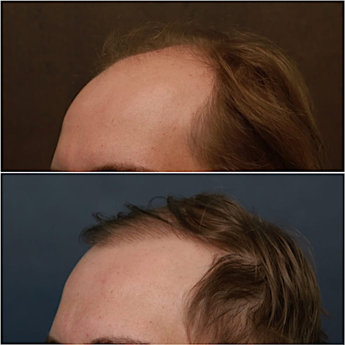 FUT Hair Restoration Before & After Gallery - Patient 58233406 - Image 4