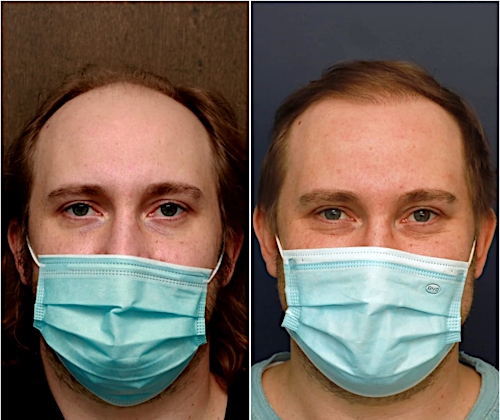 FUT Hair Restoration Before & After Gallery - Patient 58233406 - Image 5
