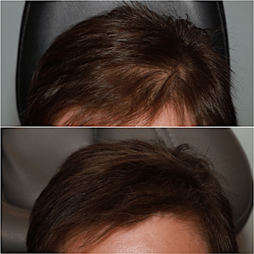 Non-Surgical Hair Restoration Before & After Gallery - Patient 58233414 - Image 1