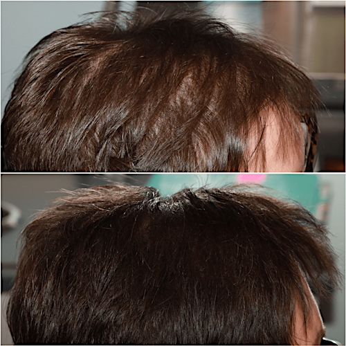 Non-Surgical Hair Restoration Before & After Gallery - Patient 58233414 - Image 2