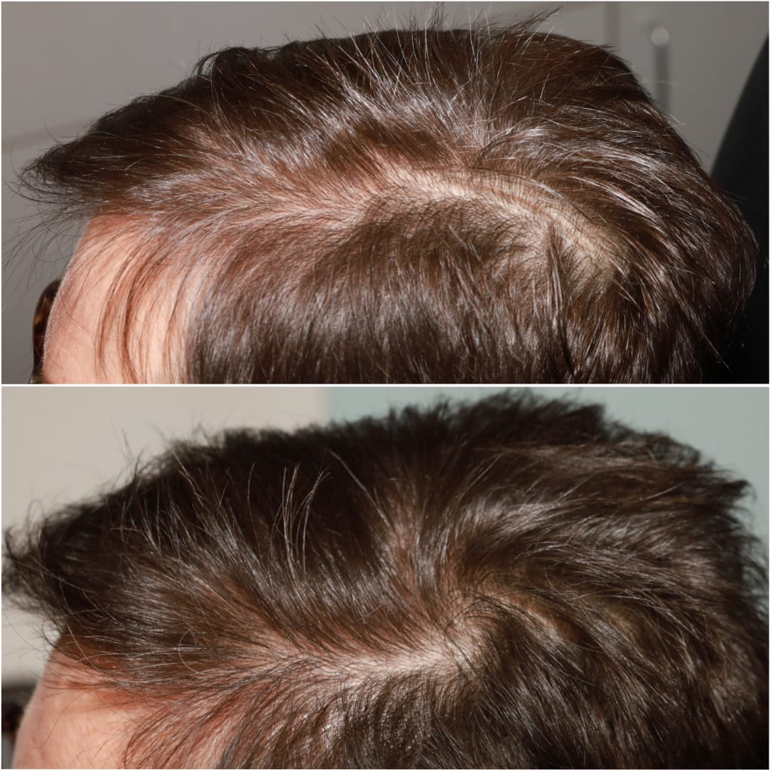 Patient 58233414 NonSurgical Hair Restoration Before & After Photos
