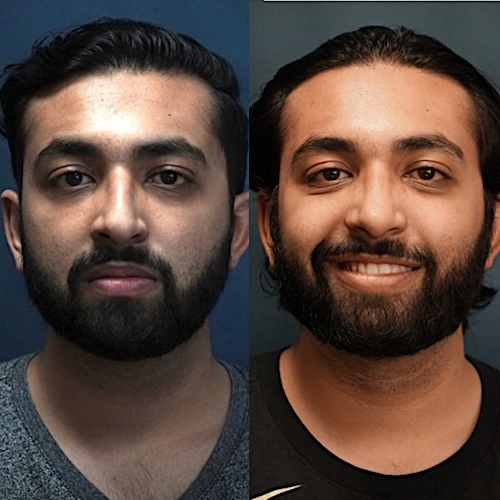 Rhinoplasty Before & After Gallery - Patient 58241557 - Image 2