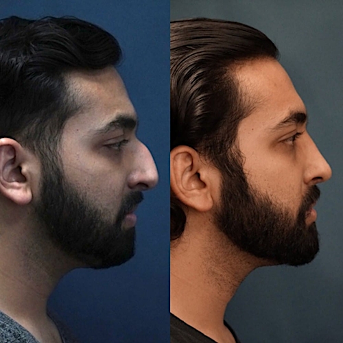 Rhinoplasty Before & After Gallery - Patient 58241557 - Image 1