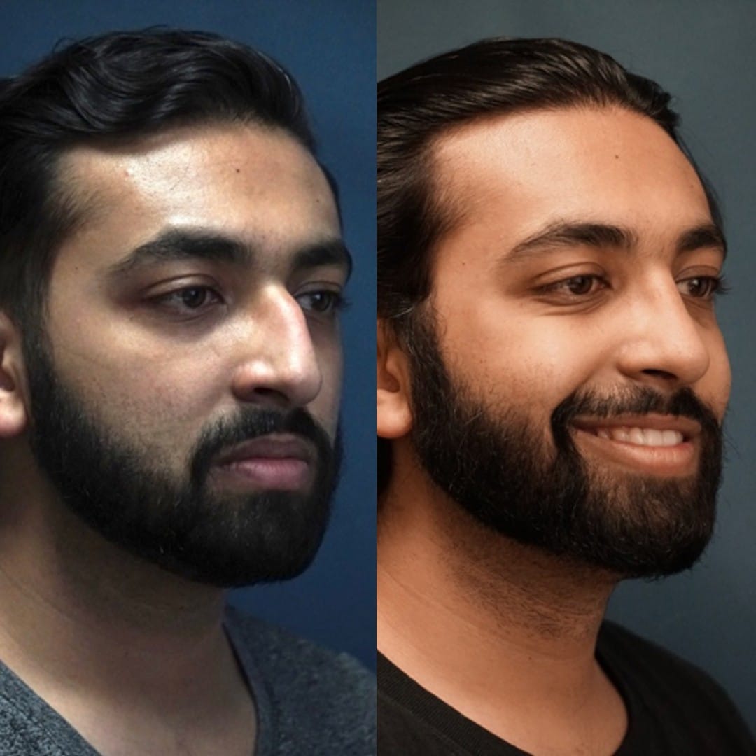 Rhinoplasty Before & After Gallery - Patient 58241557 - Image 3