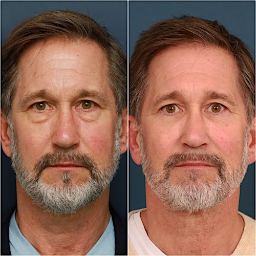 Blepharoplasty Before & After Gallery - Patient 58242479 - Image 2