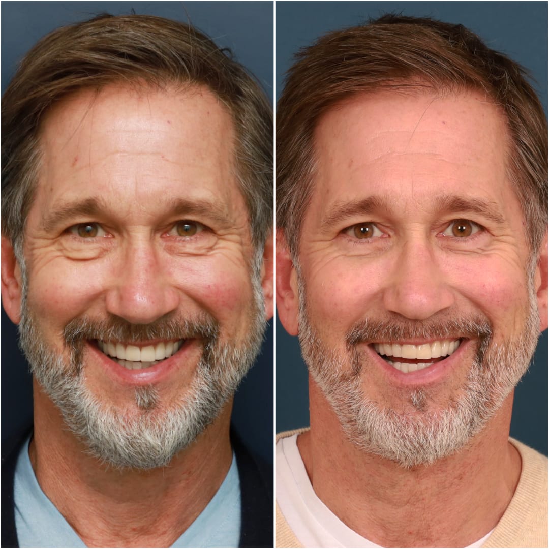 Blepharoplasty Before & After Gallery - Patient 58242479 - Image 3